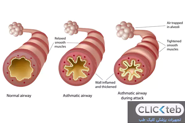 علت ابتلا به آسم