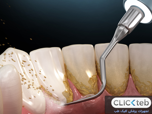 بعد از جرم گیری دندان چه غذاهایی بخوریم؟